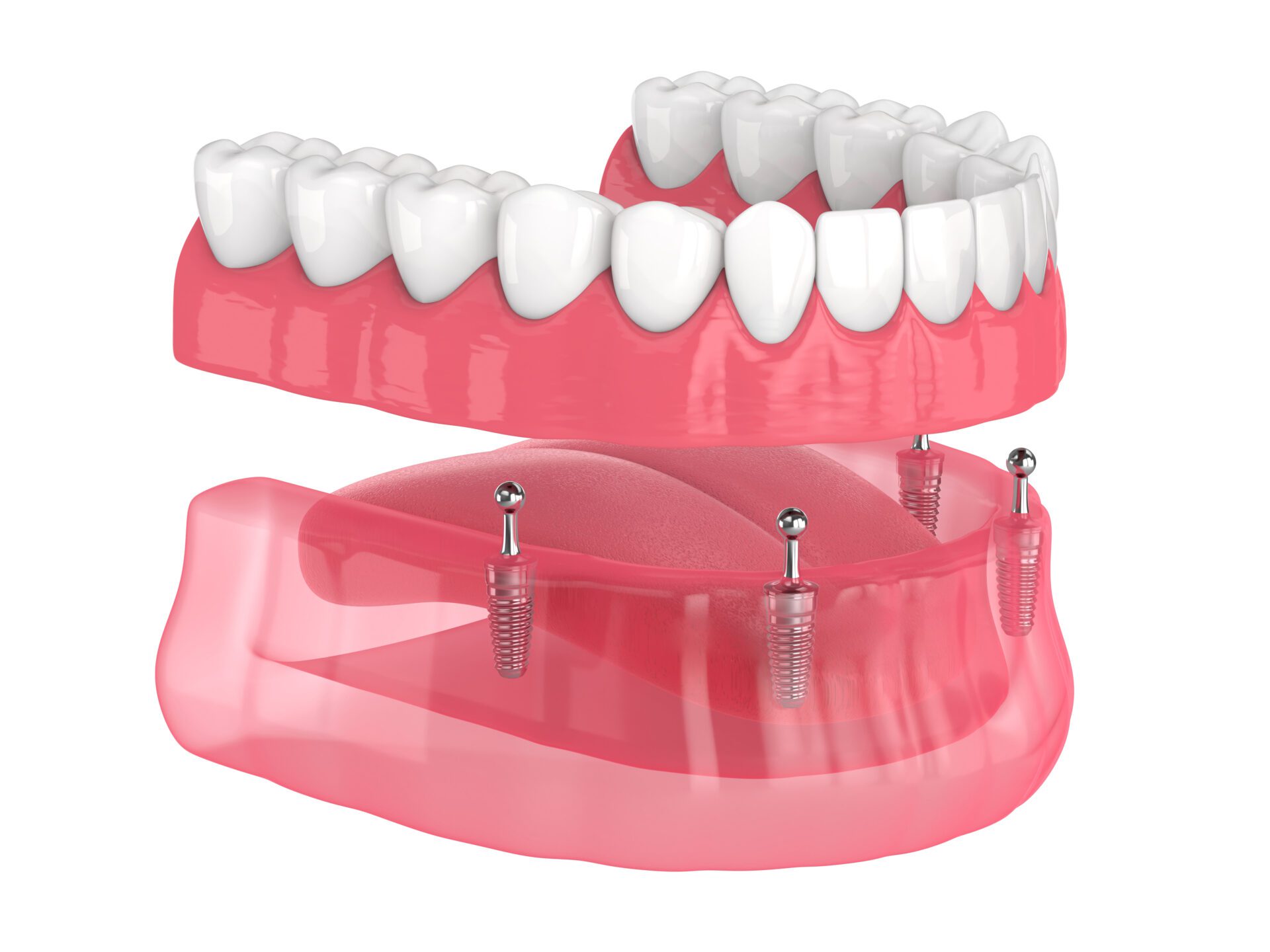 Lakeland | All-on-4 removable, implants supported, overdenture installation