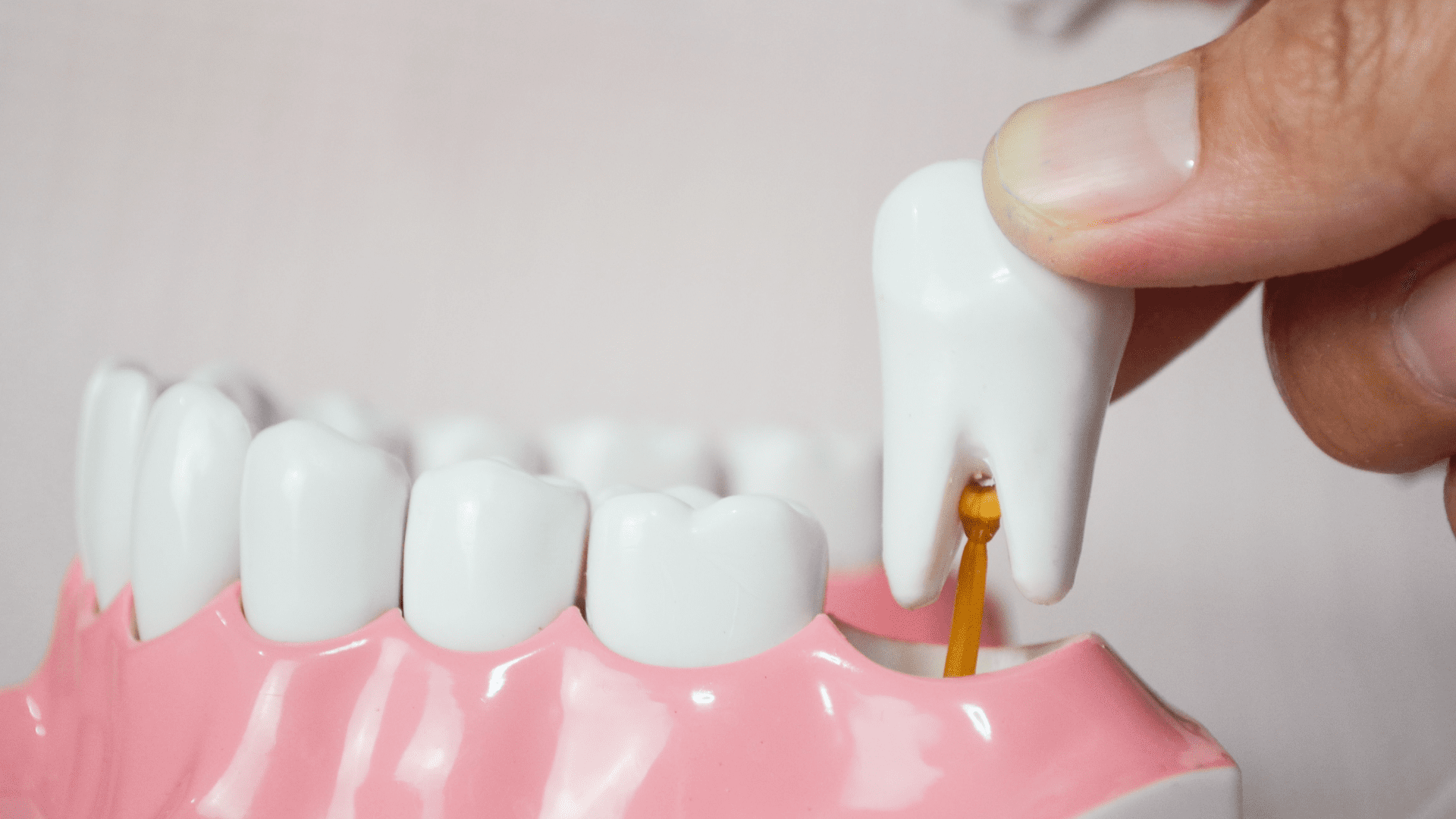 Tooth Extraction Display | Emergency Tooth Extraction Lakeland, FL
