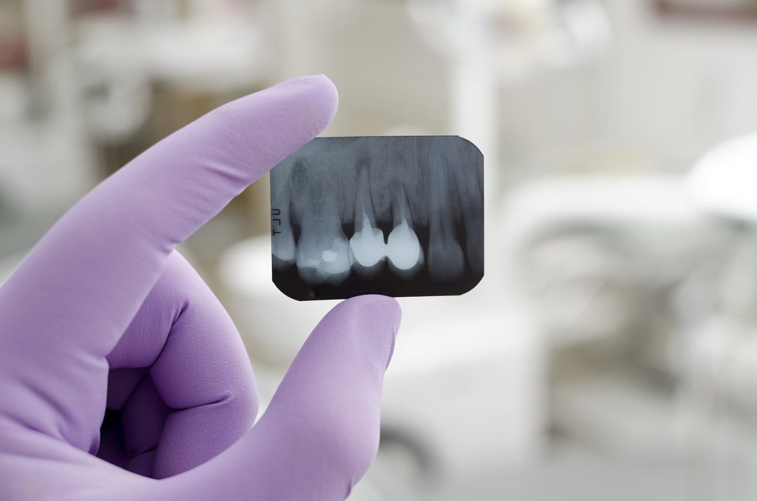 Tooth X-ray