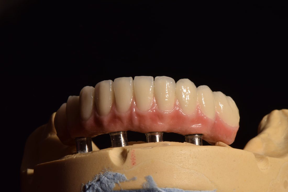 Teeth Display | All on 4 Dental Implants Lakeland, FL