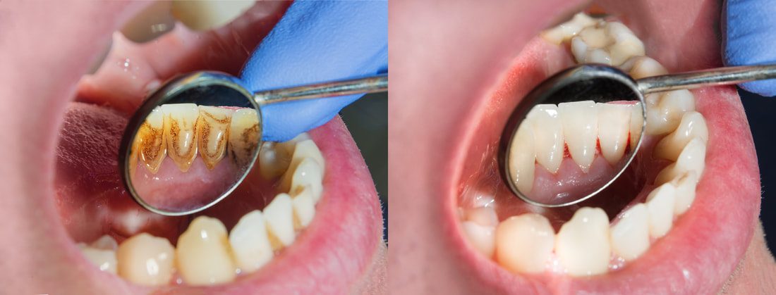 Before and After Teeth Cleaning | Smiles on Florida