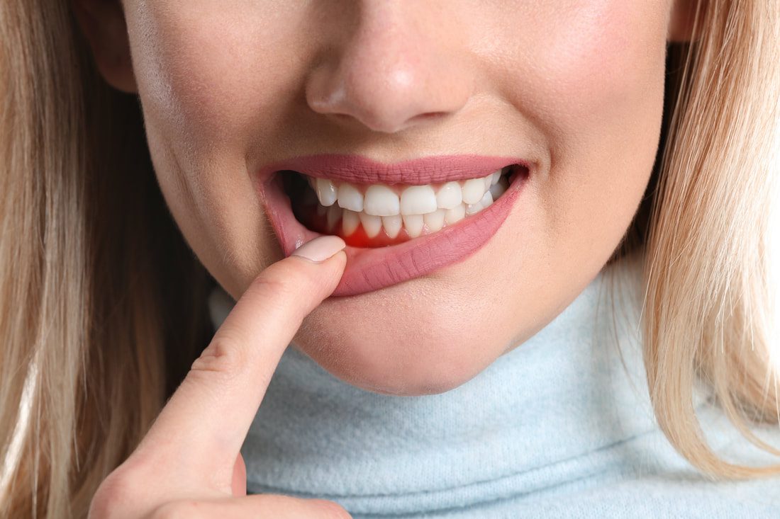 Gum Disease | Cosmetic Dentist Lakeland, FL