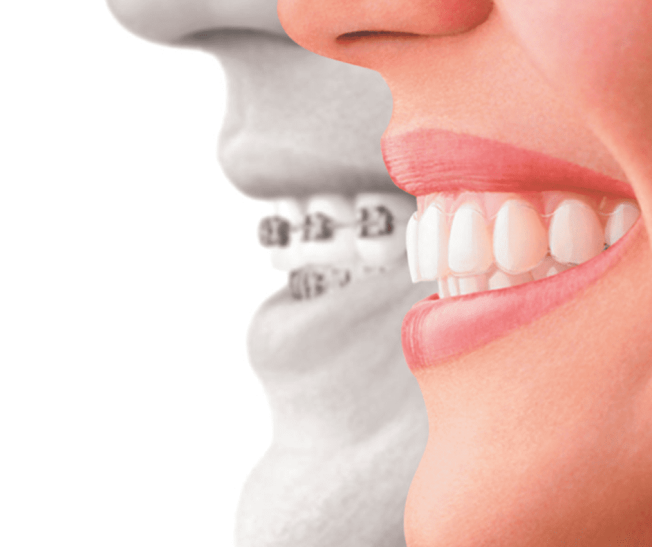 Invisalign Example