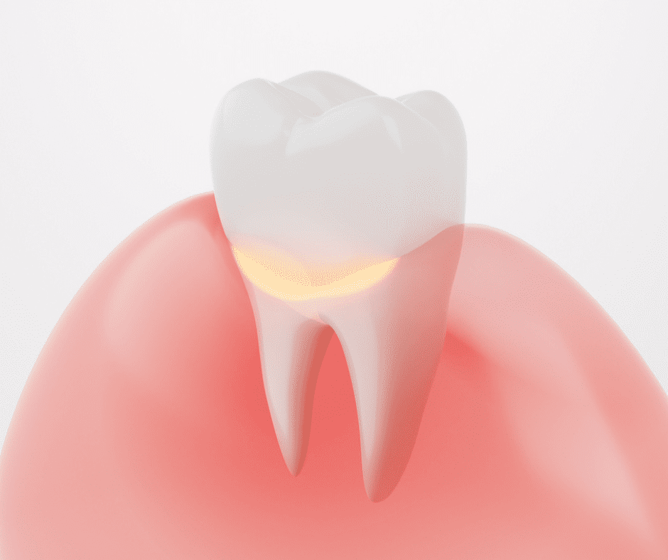 Gingivitis - Lakeland, FL