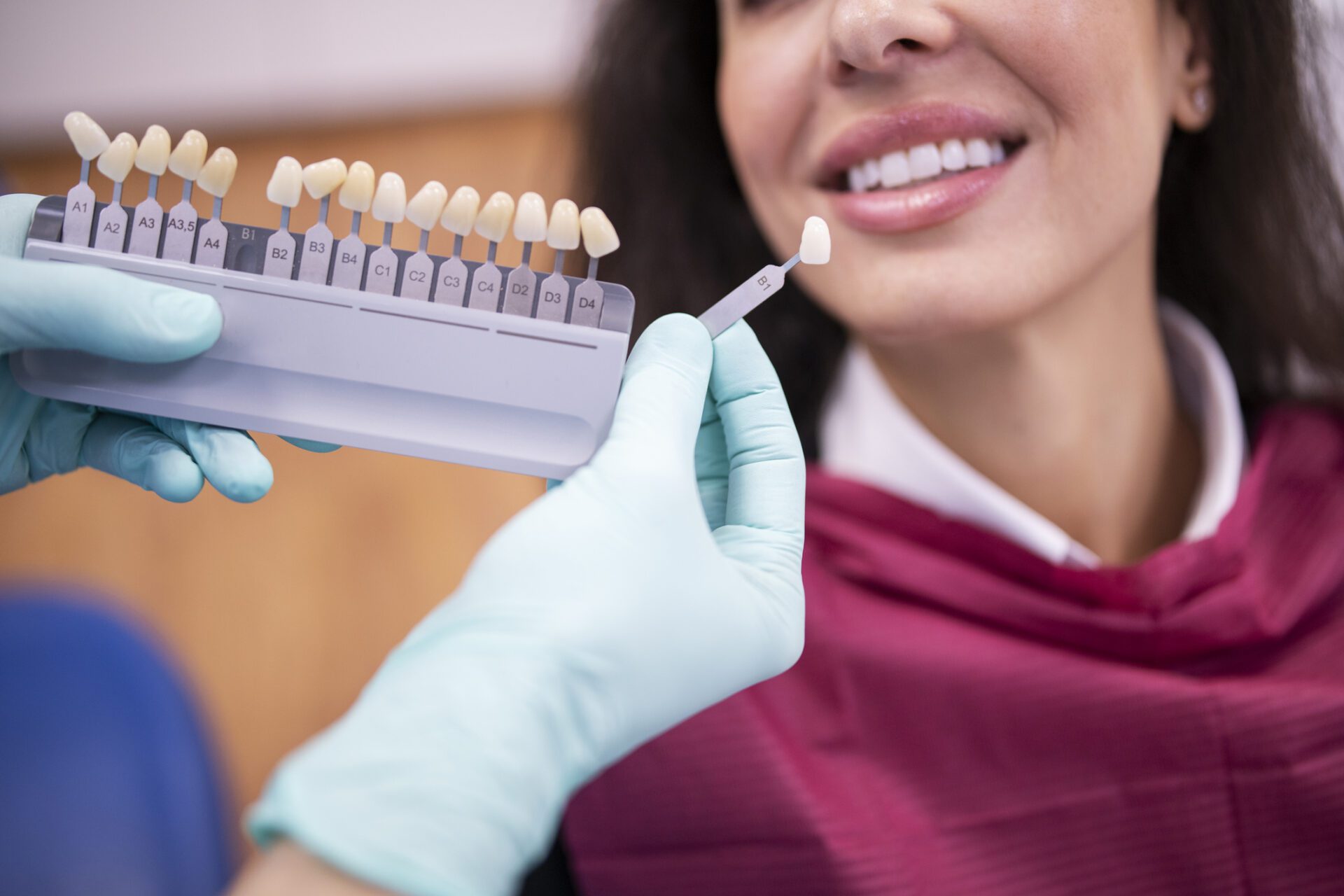 Matching Color of Veneers | Smiles on Florida